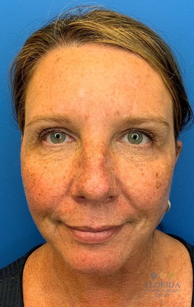 Blepharoplasty Before & After Gallery - Patient 154952048 - Image 2