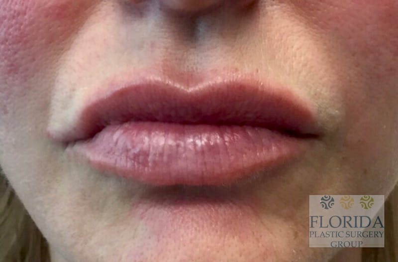 Injectables and Dermal Fillers Before & After Gallery - Patient 154952045 - Image 2