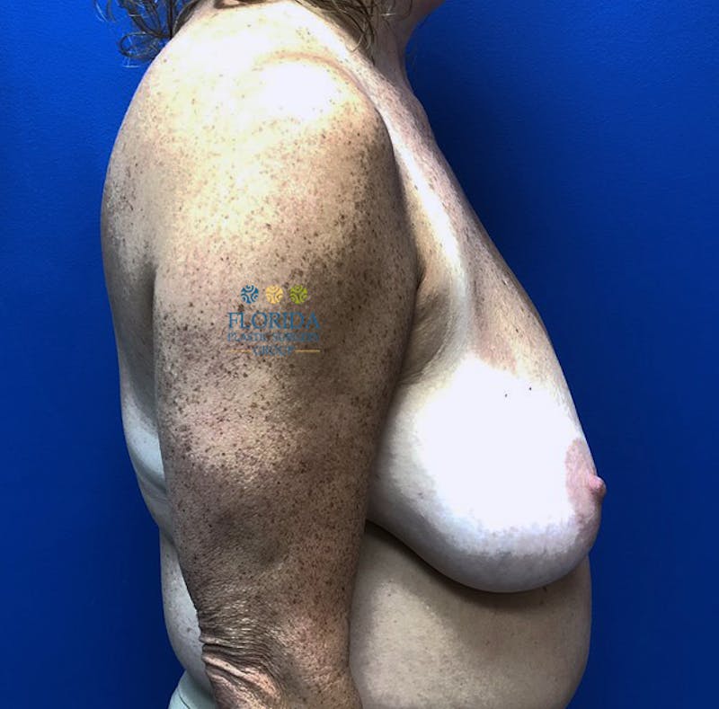 Breast Reduction Before & After Gallery - Patient 154952069 - Image 3