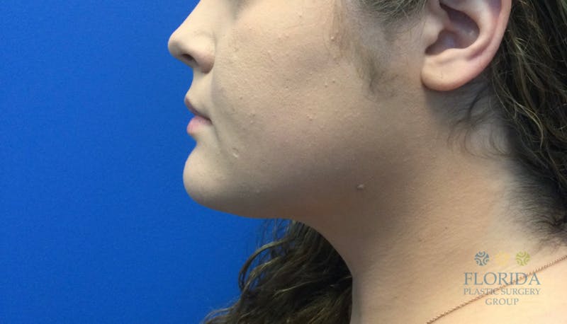 Facial Rejuvenation Before & After Gallery - Patient 154952086 - Image 4