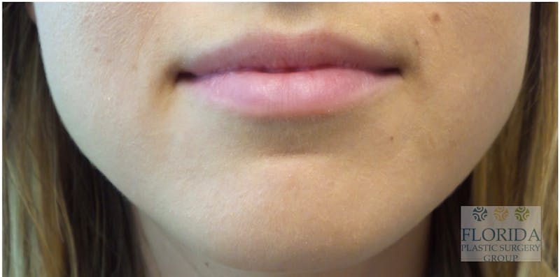 Injectables and Dermal Fillers Before & After Gallery - Patient 154952049 - Image 1