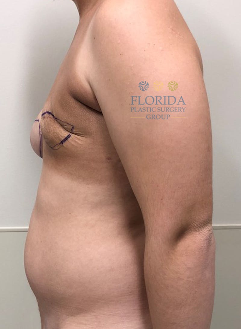 DIEP Flap Reconstruction Before & After Gallery - Patient 154952050 - Image 3