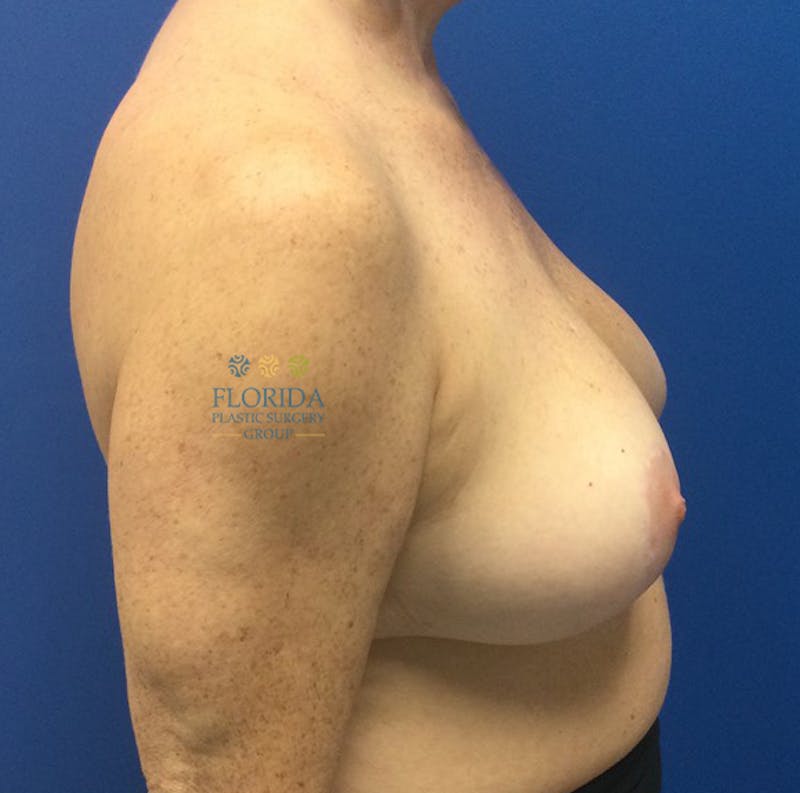 Breast Reduction Before & After Gallery - Patient 154952069 - Image 4
