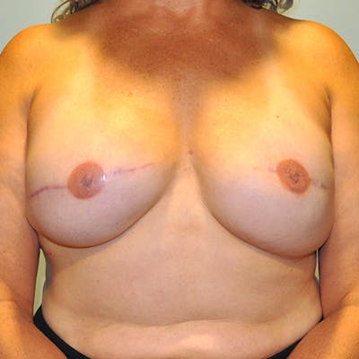 Tissue Expander Reconstruction Before & After Gallery - Patient 154952089 - Image 2