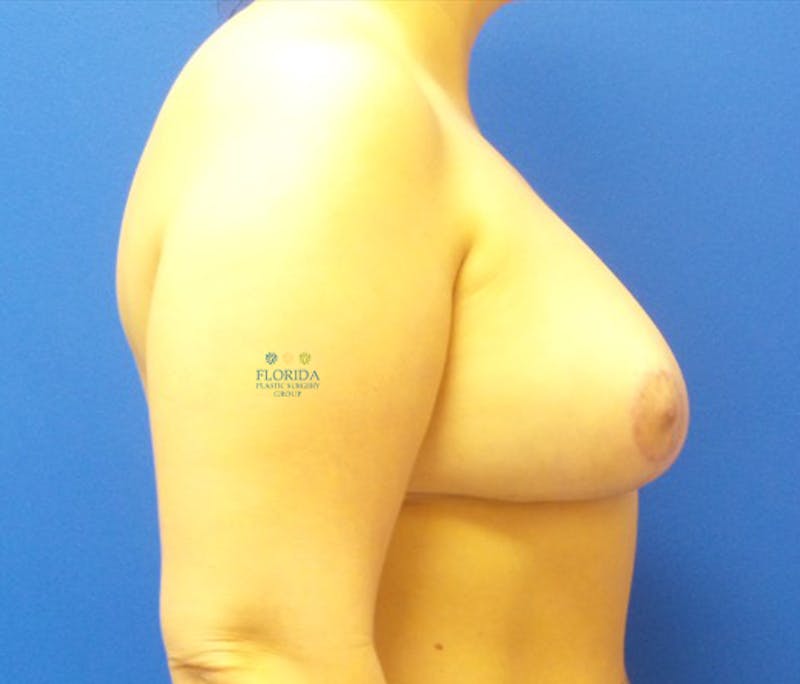 Breast Implant Removal Before & After Gallery - Patient 154952085 - Image 6