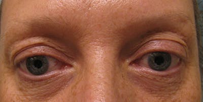 Blepharoplasty Before & After Gallery - Patient 154952091 - Image 1