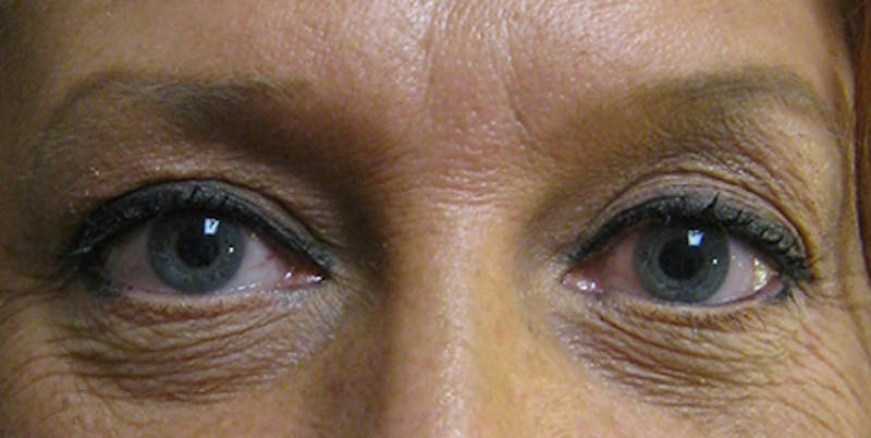 Blepharoplasty Before & After Gallery - Patient 154952091 - Image 2
