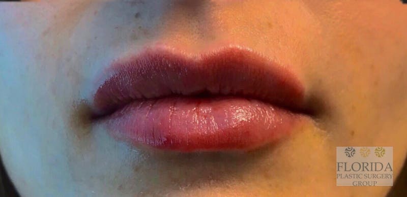 Injectables and Dermal Fillers Before & After Gallery - Patient 154952087 - Image 2