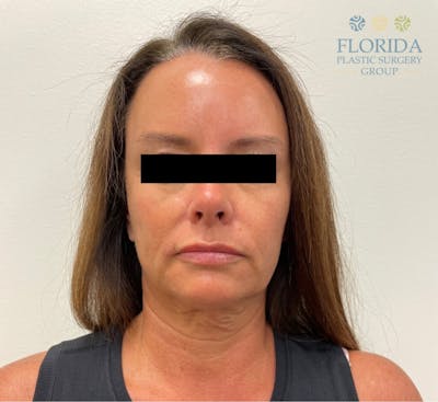 Facial Rejuvenation Before & After Gallery - Patient 154952092 - Image 1