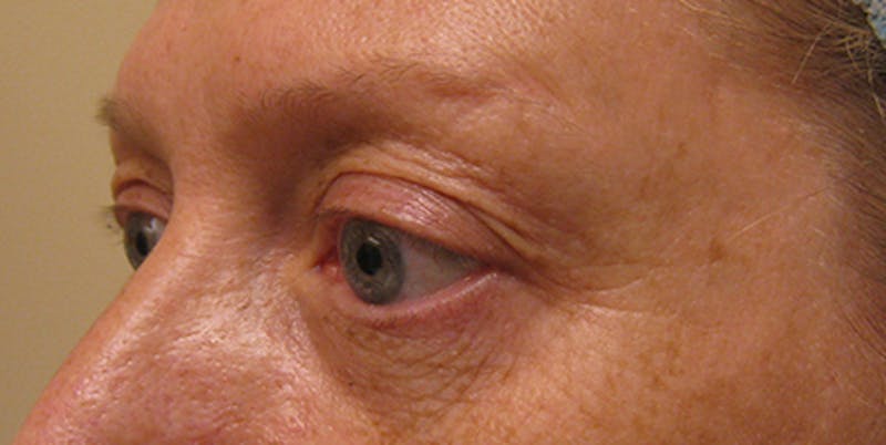 Blepharoplasty Before & After Gallery - Patient 154952091 - Image 3
