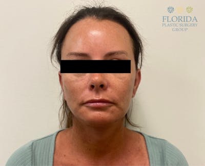Facial Rejuvenation Before & After Gallery - Patient 154952092 - Image 2