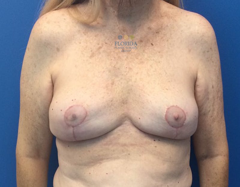 Breast Implant Removal Before & After Gallery - Patient 154952095 - Image 2
