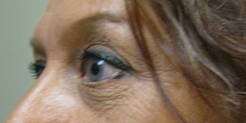 Blepharoplasty Before & After Gallery - Patient 154952091 - Image 4