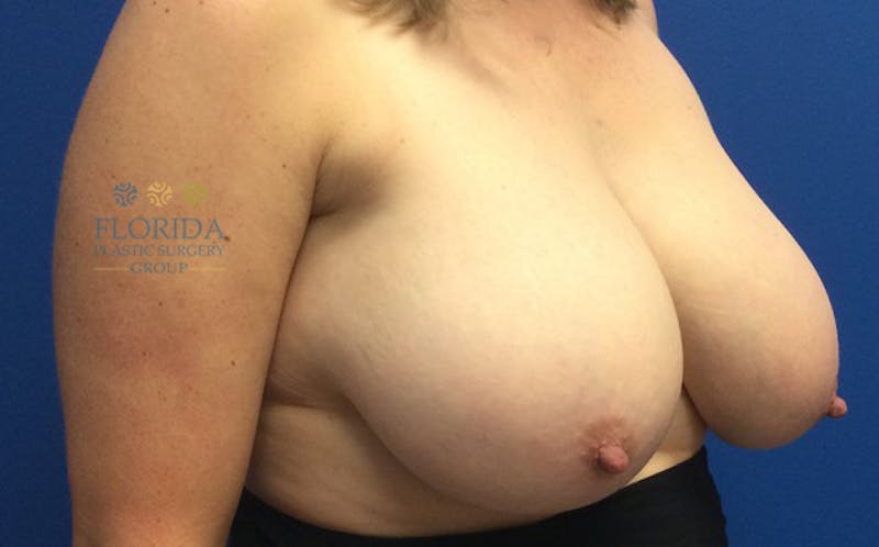 Breast Reduction Before & After Gallery - Patient 154952093 - Image 3