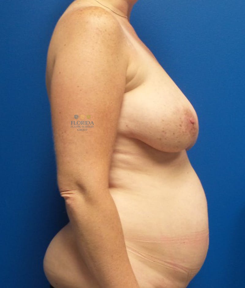 DIEP Flap Reconstruction Before & After Gallery - Patient 154952097 - Image 3