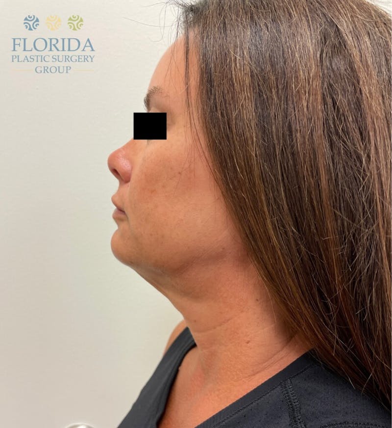 Facial Rejuvenation Before & After Gallery - Patient 154952092 - Image 3