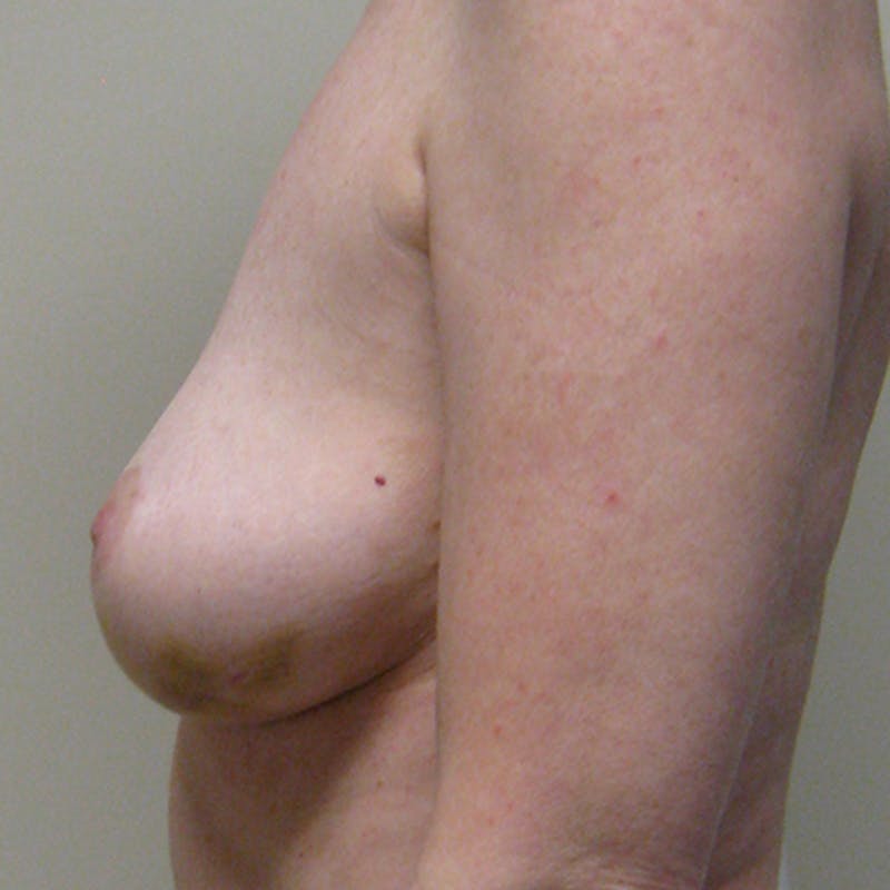 Nipple Sparing Breast Reconstruction Before & After Gallery - Patient 154952094 - Image 5