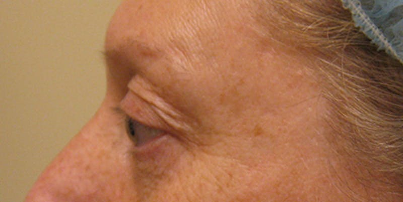 Blepharoplasty Before & After Gallery - Patient 154952091 - Image 5