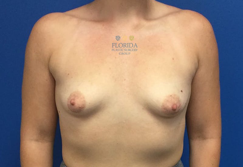 Silicone Breast Augmentation Before & After Gallery - Patient 154952108 - Image 1