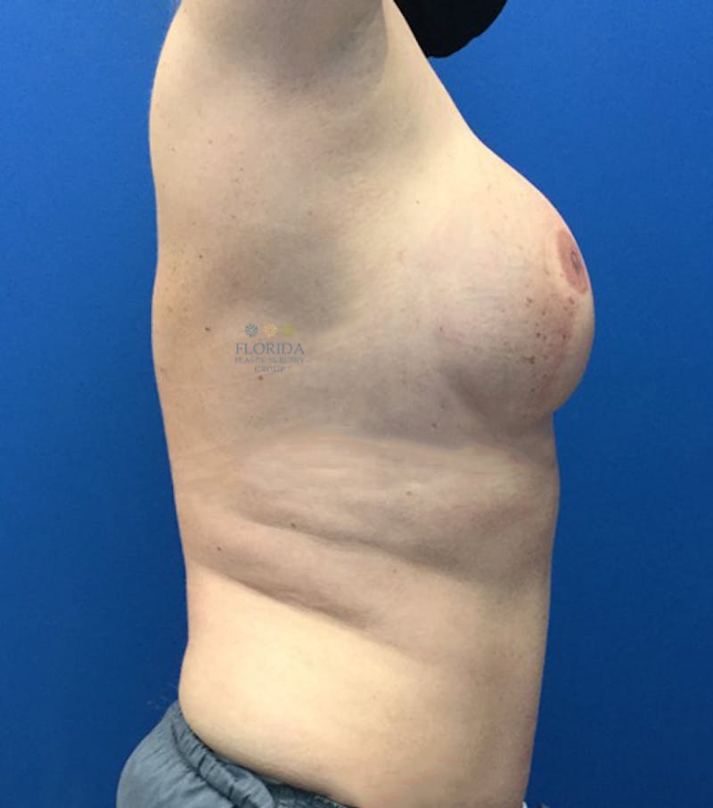 DIEP Flap Reconstruction Before & After Gallery - Patient 154952097 - Image 4