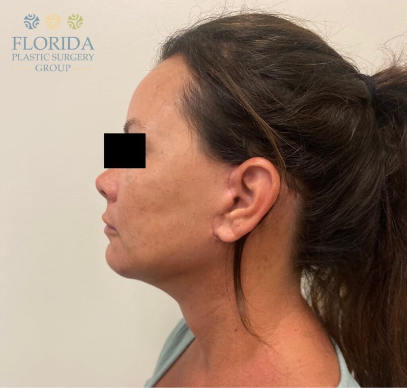 Facial Rejuvenation Before & After Gallery - Patient 154952092 - Image 4