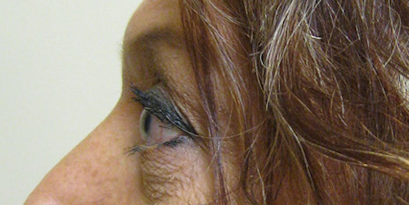 Blepharoplasty Before & After Gallery - Patient 154952091 - Image 6