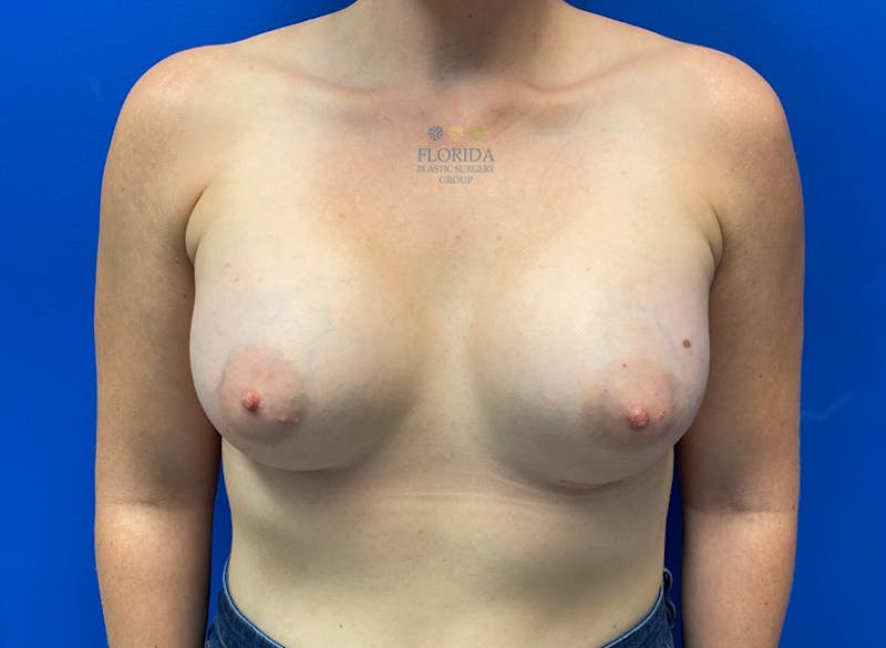 Silicone Breast Augmentation Before & After Gallery - Patient 154952108 - Image 2