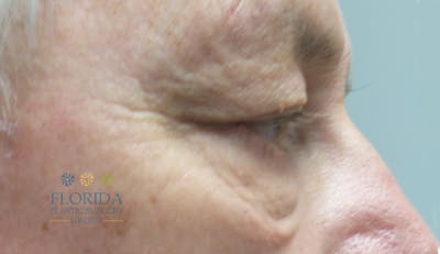 Blepharoplasty Before & After Gallery - Patient 154952098 - Image 1