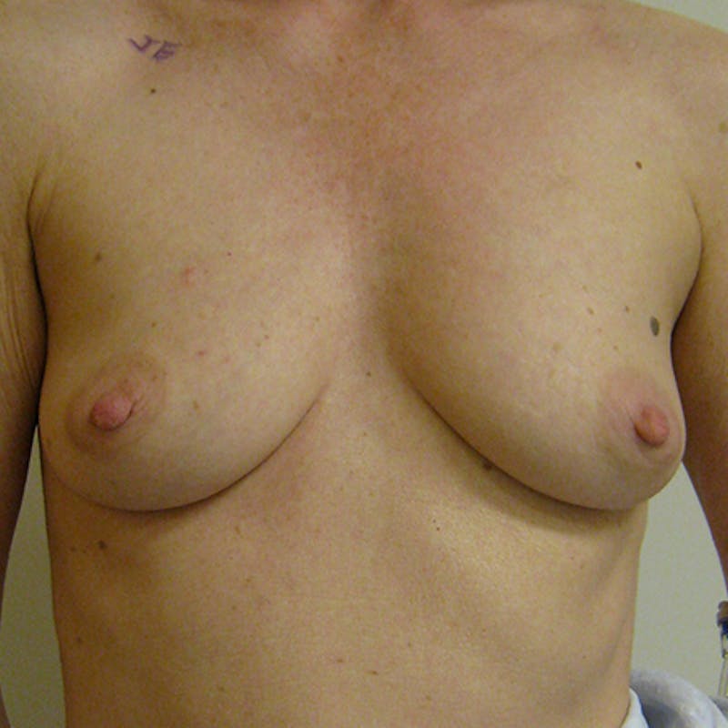 Nipple Sparing Breast Reconstruction Before & After Gallery - Patient 154952109 - Image 1