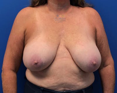 Breast Implant Removal Before & After Gallery - Patient 154952102 - Image 1