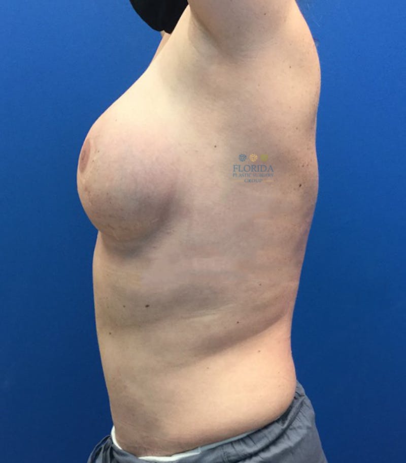DIEP Flap Reconstruction Before & After Gallery - Patient 154952097 - Image 6