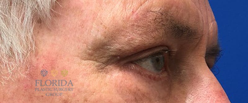 Blepharoplasty Before & After Gallery - Patient 154952098 - Image 2