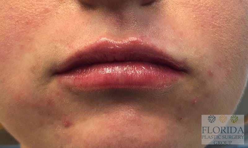Injectables and Dermal Fillers Before & After Gallery - Patient 154952099 - Image 2