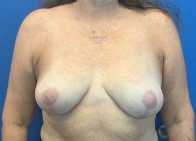 Breast Implant Removal Before & After Gallery - Patient 154952102 - Image 2