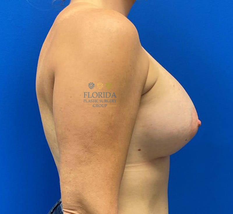 Silicone Breast Augmentation Before & After Gallery - Patient 154952108 - Image 4
