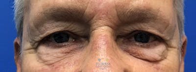 Blepharoplasty Before & After Gallery - Patient 154952103 - Image 1