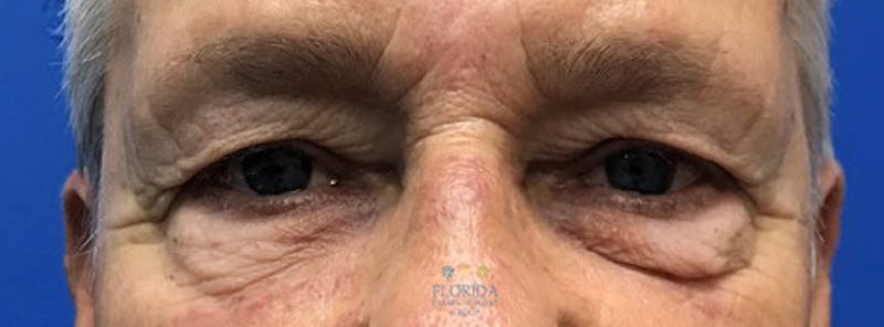 Blepharoplasty Before & After Gallery - Patient 154952103 - Image 1