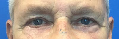 Blepharoplasty Before & After Gallery - Patient 154952103 - Image 2