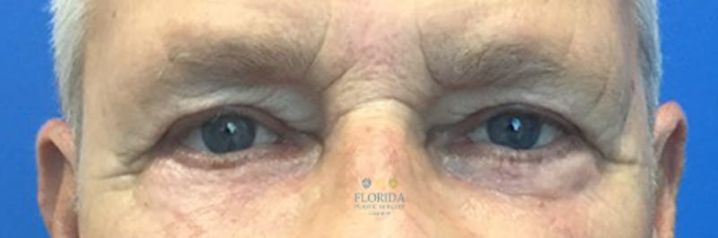 Blepharoplasty Before & After Gallery - Patient 154952103 - Image 2