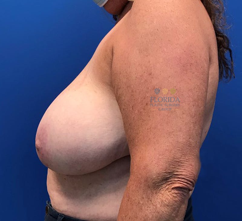 Breast Implant Removal Before & After Gallery - Patient 154952102 - Image 3