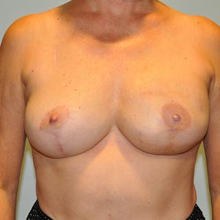 DIEP Flap Reconstruction Before & After Gallery - Patient 154952105 - Image 2