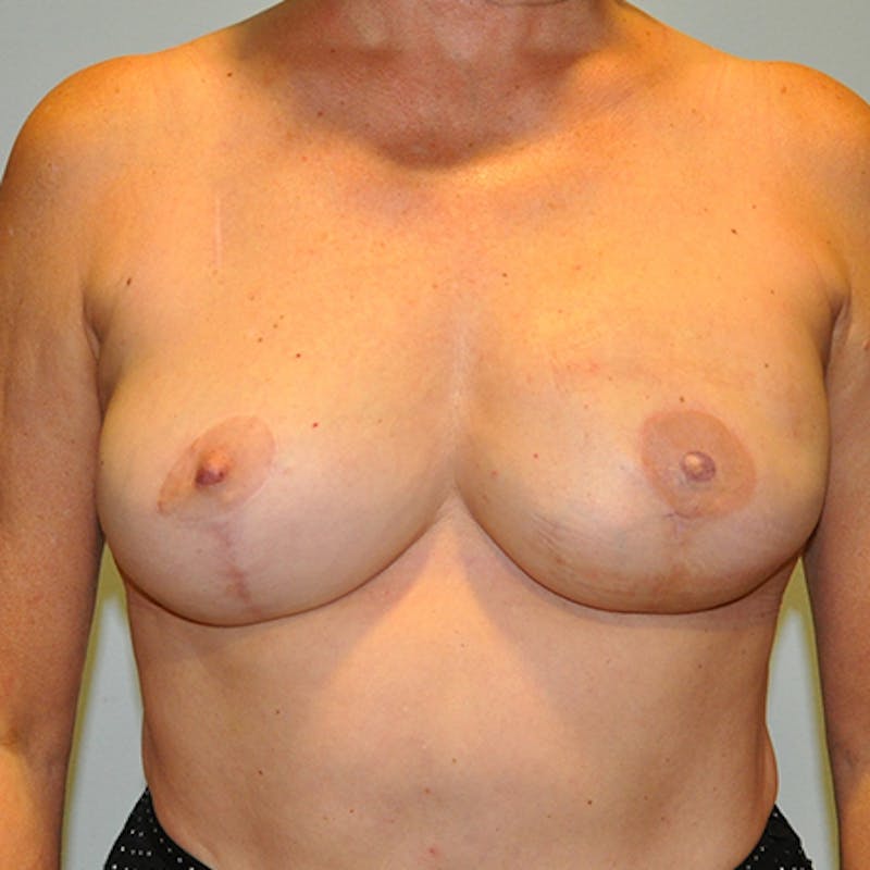 DIEP Flap Reconstruction Before & After Gallery - Patient 154952105 - Image 2