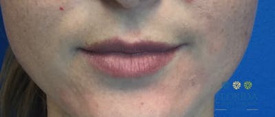 Injectables and Dermal Fillers Before & After Gallery - Patient 154952101 - Image 1