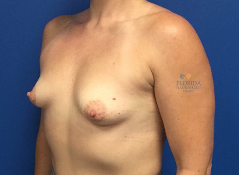 Silicone Breast Augmentation Before & After Gallery - Patient 154952108 - Image 5