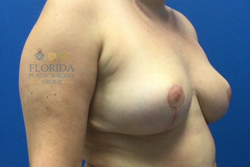 Breast Reduction Before & After Gallery - Patient 154952104 - Image 4