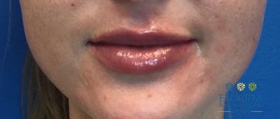 Injectables and Dermal Fillers Before & After Gallery - Patient 154952101 - Image 2