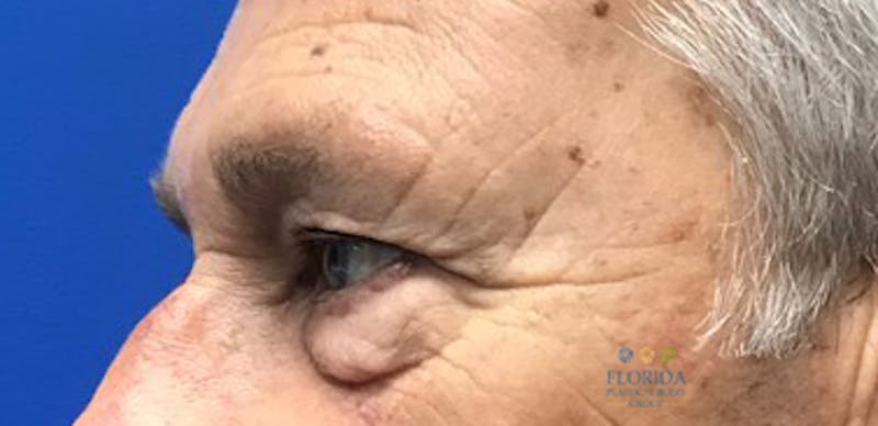 Blepharoplasty Before & After Gallery - Patient 154952103 - Image 3