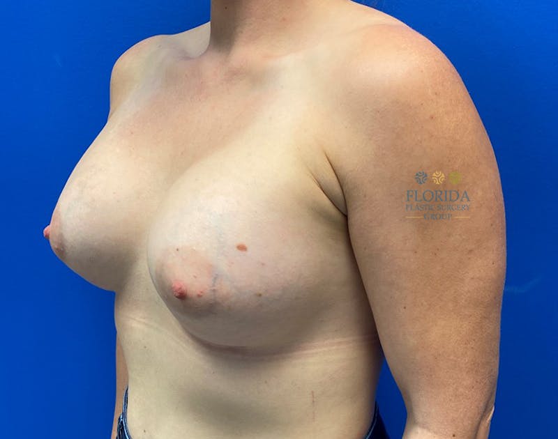 Silicone Breast Augmentation Before & After Gallery - Patient 154952108 - Image 6