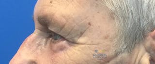 Blepharoplasty Before & After Gallery - Patient 154952103 - Image 4
