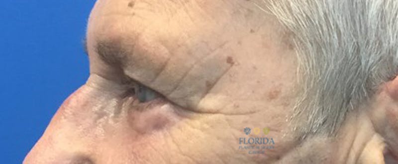 Blepharoplasty Before & After Gallery - Patient 154952103 - Image 4